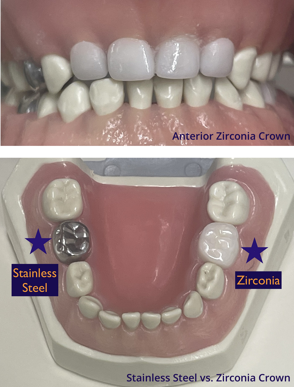 Zirconia Crown